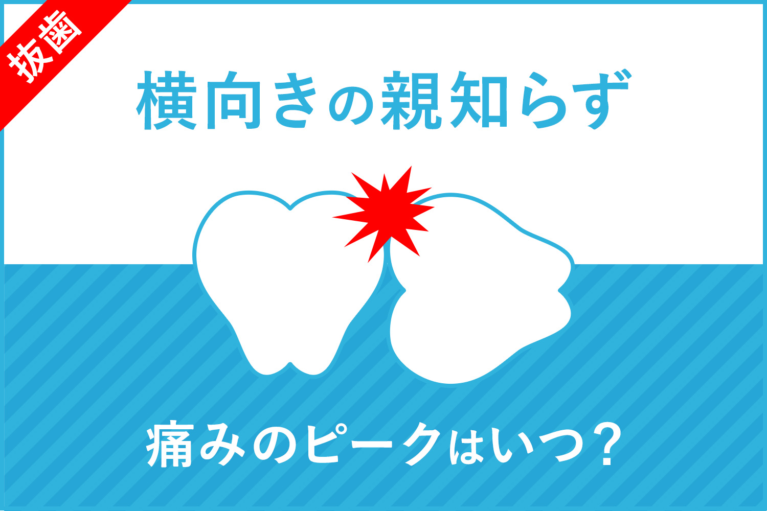 【体験談】痛みのピークはいつ？横向き親知らず抜歯後1日目〜6日目の痛みの経過まとめ