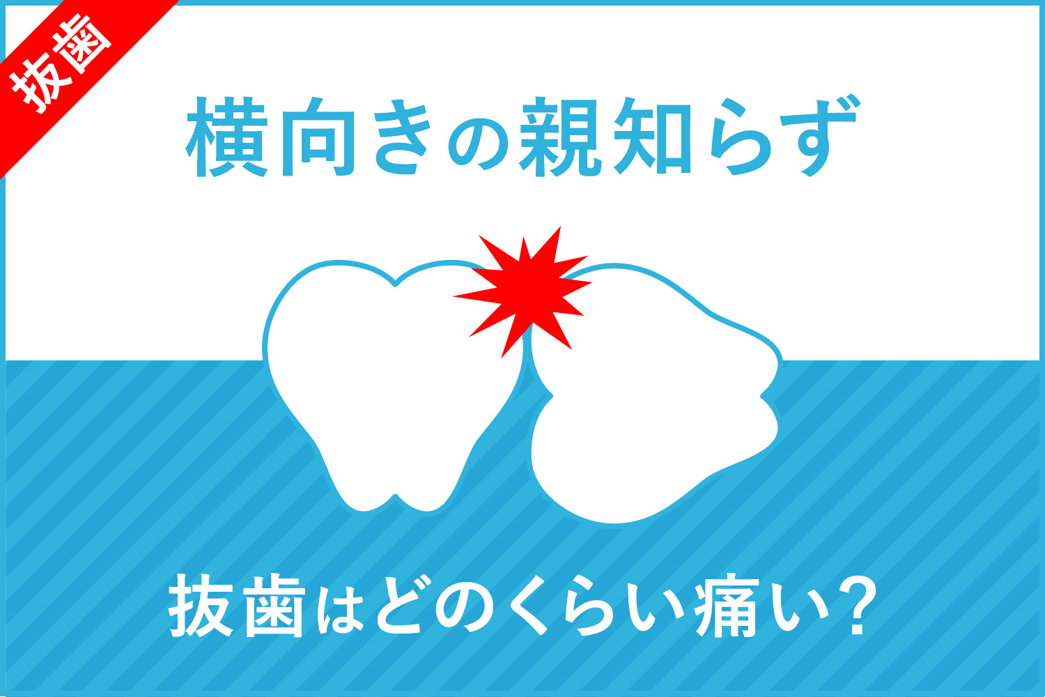 【体験談】横向き親知らずの抜歯は激痛？意外な結果だった抜歯体験 (抜歯当日)