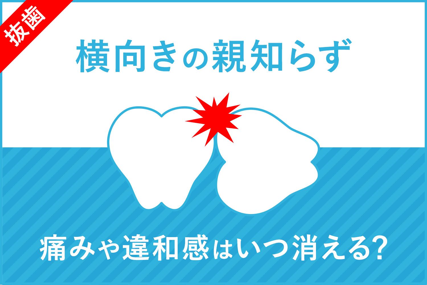 【体験談】横向き親知らず抜歯後3週間目と1ヶ月目。痛みや違和感の変化は？